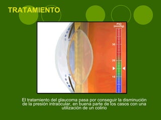 TRATAMIENTO El tratamiento del glaucoma pasa por conseguir la disminución de la presión intraocular, en buena parte de los casos con una utilización de un colirio 