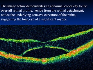 The image below demonstrates an abnormal concavity to the over-all retinal profile.  Aside from the retinal detachment, notice the underlying concave curvature of the retina, suggesting the long eye of a significant myope. 