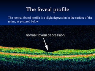 The foveal profile The normal foveal profile is a slight depression in the surface of the retina, as pictured below. 