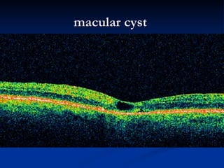macular cyst  