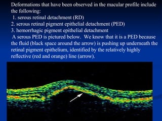 Deformations that have been observed in the macular profile include the following:   1. serous retinal detachment (RD) 2. serous retinal pigment epithelial detachment (PED) 3. hemorrhagic pigment epithelial detachment   A serous PED is pictured below.  We know that it is a PED because the fluid (black space around the arrow) is pushing up underneath the retinal pigment epithelium, identified by the relatively highly reflective (red and orange) line (arrow).   