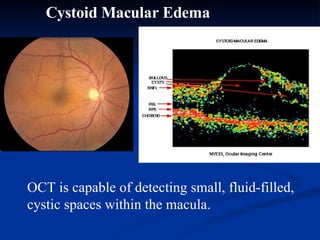 Cystoid Macular Edema OCT is capable of detecting small, fluid-filled, cystic spaces within the macula. 