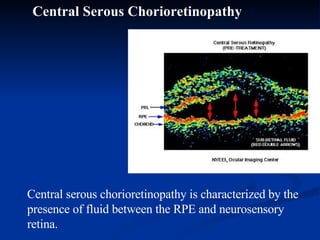 Central Serous Chorioretinopathy Central serous chorioretinopathy is characterized by the presence of fluid between the RPE and neurosensory retina. 