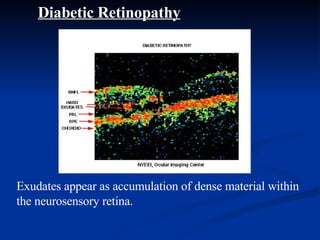 Diabetic Retinopathy Exudates appear as accumulation of dense material within the neurosensory retina. 
