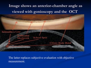 Image shows an anterior-chamber angle as viewed with gonioscopy and the  OCT   The latter replaces subjective evaluation with objective measurement.  