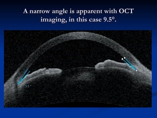 A narrow angle is apparent with OCT imaging, in this case 9.5°. 