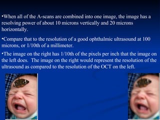 When all of the A-scans are combined into one image, the image has a resolving power of about 10 microns vertically and 20 microns horizontally.  Compare that to the resolution of a good ophthalmic ultrasound at 100 microns, or 1/10th of a millimeter.   The image on the right has 1/10th of the pixels per inch that the image on the left does.  The image on the right would represent the resolution of the ultrasound as compared to the resolution of the OCT on the left.  