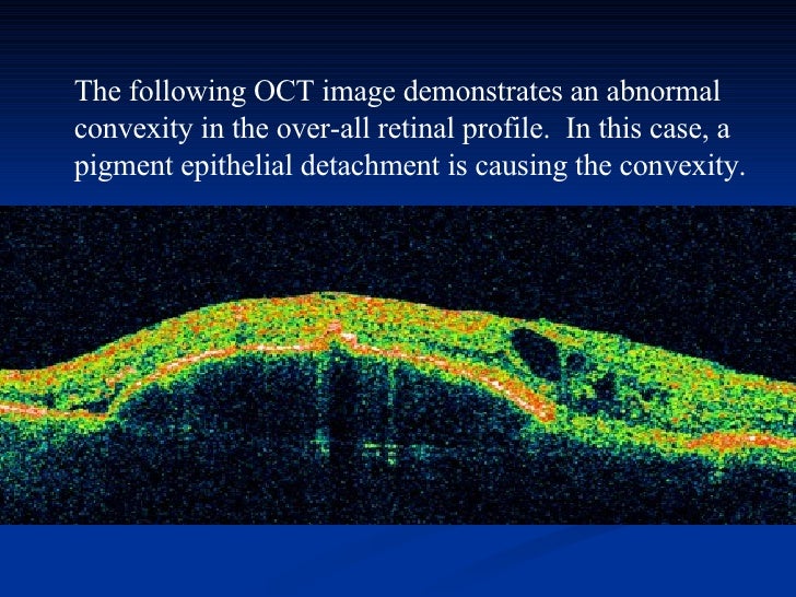 Optical Coherence Tomography principle and uses in ophthalmology