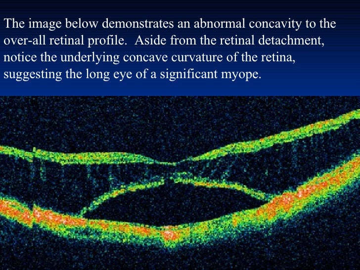 Optical Coherence Tomography principle and uses in ophthalmology