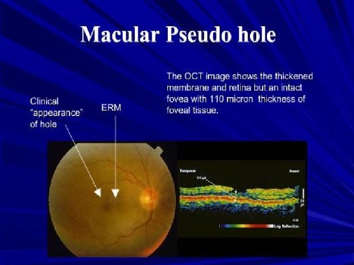Optical Coherence Tomography principle and uses in ophthalmology