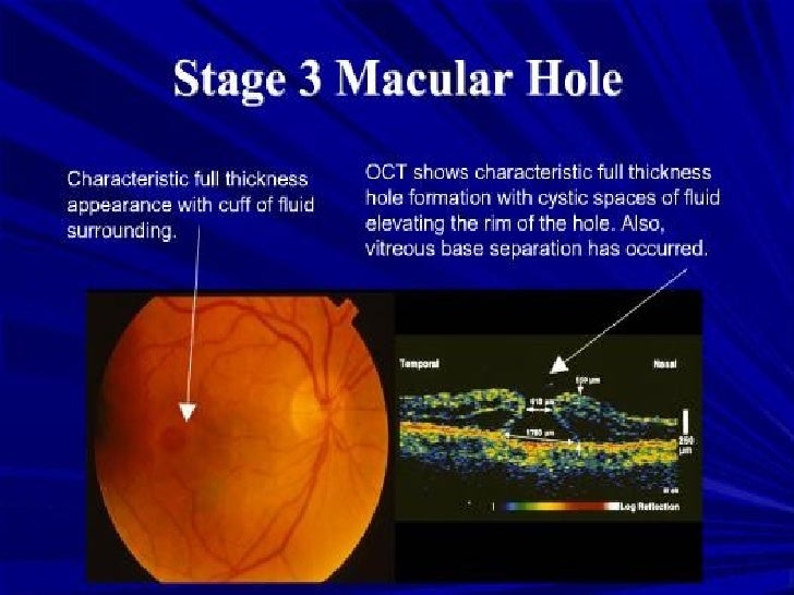 Optical Coherence Tomography principle and uses in ophthalmology