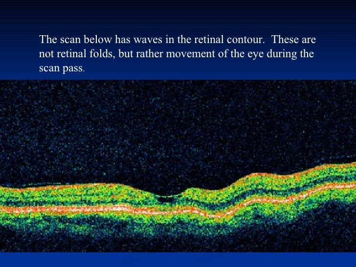 Optical Coherence Tomography Optical Coherence Tomography