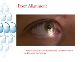 Lenstar LS 900 (Haag-Streit)