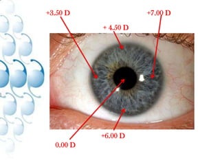 Multifocal / Accommodating IOL’s