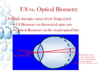 Measurement along the Visual AxisVisual axis(Patient fixates on the measurement beam)Ultrasound BiometerTheoretical Optical Axis≈ 90°Optical BiometerVisual axis