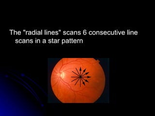 The "radial lines" scans 6 consecutive line scans in a star pattern  