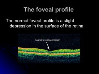 The foveal profile   The normal foveal profile is a slight depression in the surface of the retina  