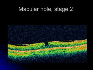 Macular hole, stage 2  