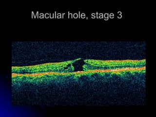 Macular hole, stage 3  