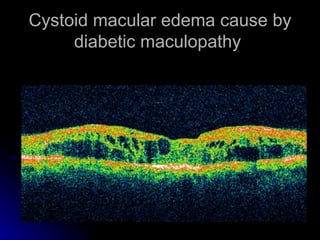 Cystoid macular edema cause by diabetic maculopathy  