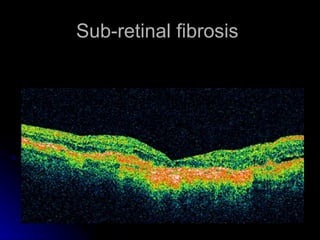 Sub-retinal fibrosis  