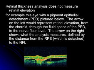 Retinal thickness analysis does not measure retinal  elevation   for example this eye with a pigment epithelial detachment (PED) pictured below.  The arrow on the left would represent retinal elevation, from the choroid, through the fluid space of the PED, to the nerve fiber level.  The arrow on the right shows what the analysis measures, defined by the distance from the RPE (which is detached) to the NFL  