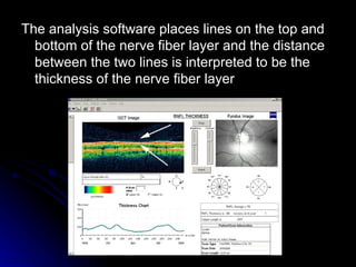 The analysis software places lines on the top and bottom of the nerve fiber layer and the distance between the two lines is interpreted to be the thickness of the nerve fiber layer  