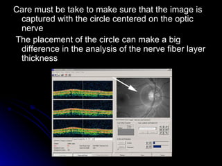 Care must be take to make sure that the image is captured with the circle centered on the optic nerve The placement of the circle can make a big difference in the analysis of the nerve fiber layer thickness  