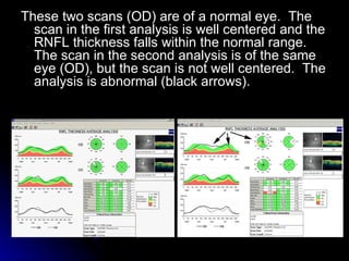 These two scans (OD) are of a normal eye.  The scan in the first analysis is well centered and the RNFL thickness falls within the normal range.  The scan in the second analysis is of the same eye (OD), but the scan is not well centered.  The analysis is abnormal (black arrows).  