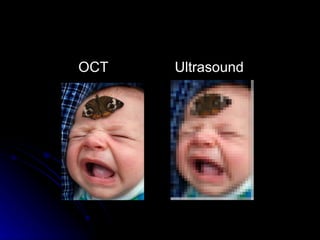 OCT     Ultrasound                                                                                