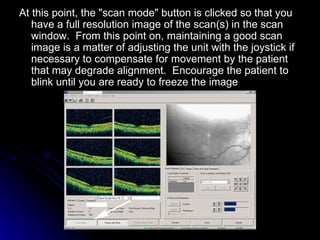 At this point, the "scan mode" button is clicked so that you have a full resolution image of the scan(s) in the scan window.  From this point on, maintaining a good scan image is a matter of adjusting the unit with the joystick if necessary to compensate for movement by the patient that may degrade alignment.  Encourage the patient to blink until you are ready to freeze the image  