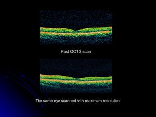 Fast OCT 3 scan  The same eye scanned with maximum resolution  