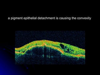 a pigment epithelial detachment is causing the convexity  