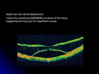 Aside from the retinal detachment, notice the underlying  concave  curvature of the retina,  suggesting the long eye of a ...
