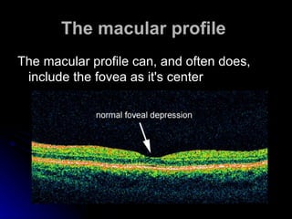 The macular profile   <ul><li>The macular profile can, and often does,  include the fovea as it's center  </li></ul>