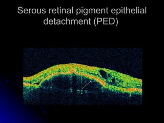 Serous retinal pigment epithelial detachment (PED)  