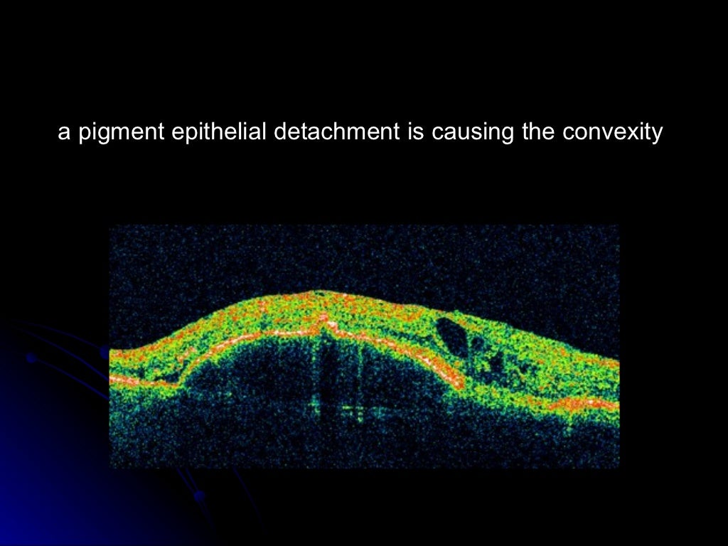 Optical coherence tomography