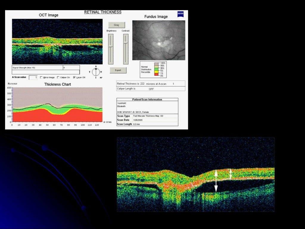 Optical coherence tomography