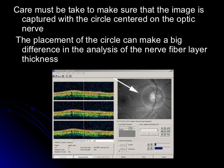 Optical coherence tomography