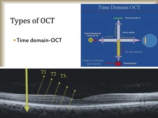 Time domain-OCT
Types of OCT
 