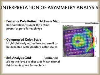  Posterior Pole Retinal Thickness Map
Retinal thickness over the entire
posterior pole for each eye
 Compressed Color Scale
Highlight early retinal loss too small to
be detected with standard color scales
 8x8 Analysis Grid Positioned
along the fovea to disc axis Mean retinal
thickness is given for each cell
 