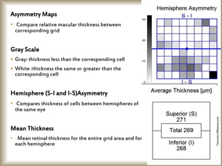 Asymmetry Maps
• Compare relative macular thickness between
corresponding grid
Gray Scale
 Gray: thickness less than the corresponding cell
 White :thickness the same or greater than the
corresponding cell
Hemisphere (S-I and I-S)Asymmetry
• Compares thickness of cells between hemispheres of
the same eye
Mean Thickness
• Mean retinal thickness for the entire grid area and for
each hemisphere
 