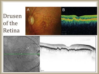 Drusen
of the
Retina
 