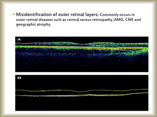  Misidentification of outer retinal layers: Commonly occurs in
outer retinal diseases such as central serous retinopathy ,AMD, CME and
geographic atrophy.
 