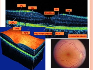 PHOTORECEPTORSRPE
CHORIOCAPILLARIS
NFL
FOVEOLA
GCL
ELM
ONL
OPL
INL
IPL
 
