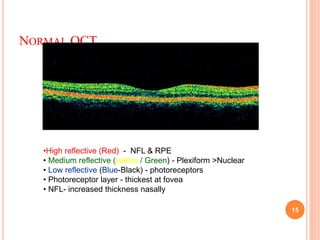 NORMAL OCT
15
•High reflective (Red) - NFL & RPE
• Medium reflective (yellow / Green) - Plexiform >Nuclear
• Low reflective (Blue-Black) - photoreceptors
• Photoreceptor layer - thickest at fovea
• NFL- increased thickness nasally
 