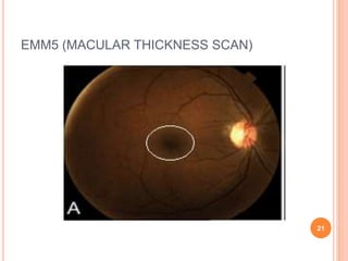 EMM5 (MACULAR THICKNESS SCAN)
21
 