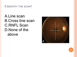 5.IDENTIFY THE SCAN?
36
A.Line scan
B.Cross line scan
C.RNFL Scan
D.None of the
above
 