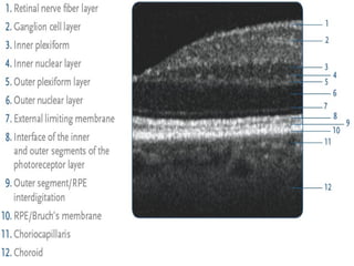 Optical Coherence Tomography - retinal layers.pptx