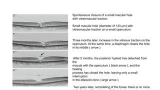 Spontaneous closure of a small macular hole
with vitreomacular traction.
Small macular hole (diameter of 133 μm) with
vitreomacular traction on a small operculum.
Three months later, increase in the vitreous traction on the
operculum. At the same time, a diaphragm closes the hole
in its middle ( arrow ).
After 5 months, the posterior hyaloid has detached from
the
macula with the operculum ( black arrow ), and the
healing
process has closed the hole, leaving only a small
interruption
in the ellipsoid zone ( large arrow ).
Two years later, remodeling of the fovea: there is no more
 